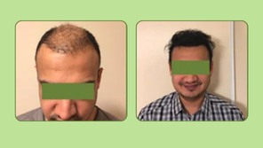 Hair Transplant result